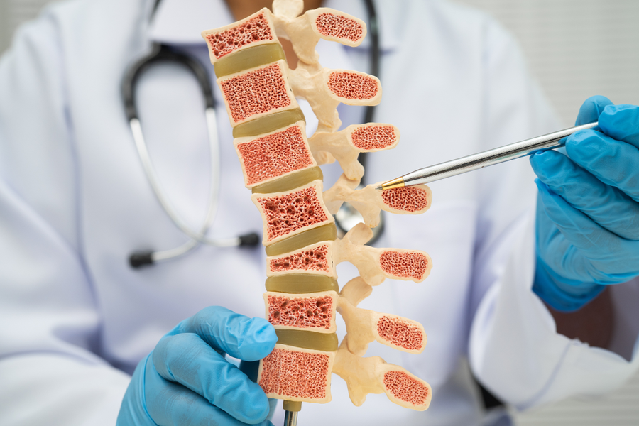 Understanding Bone Health in Midlife: The Role of Hormones, Gut Health, and Fracture Prevention