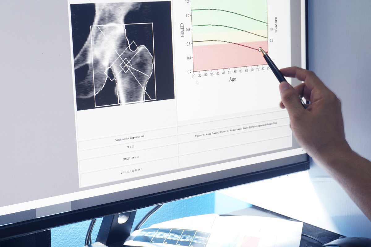 What DexaFit Data Reveals About Bone Loss: A Webinar Recap
